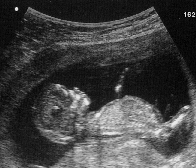 Birth Injuries Resulting from Placental Abruption