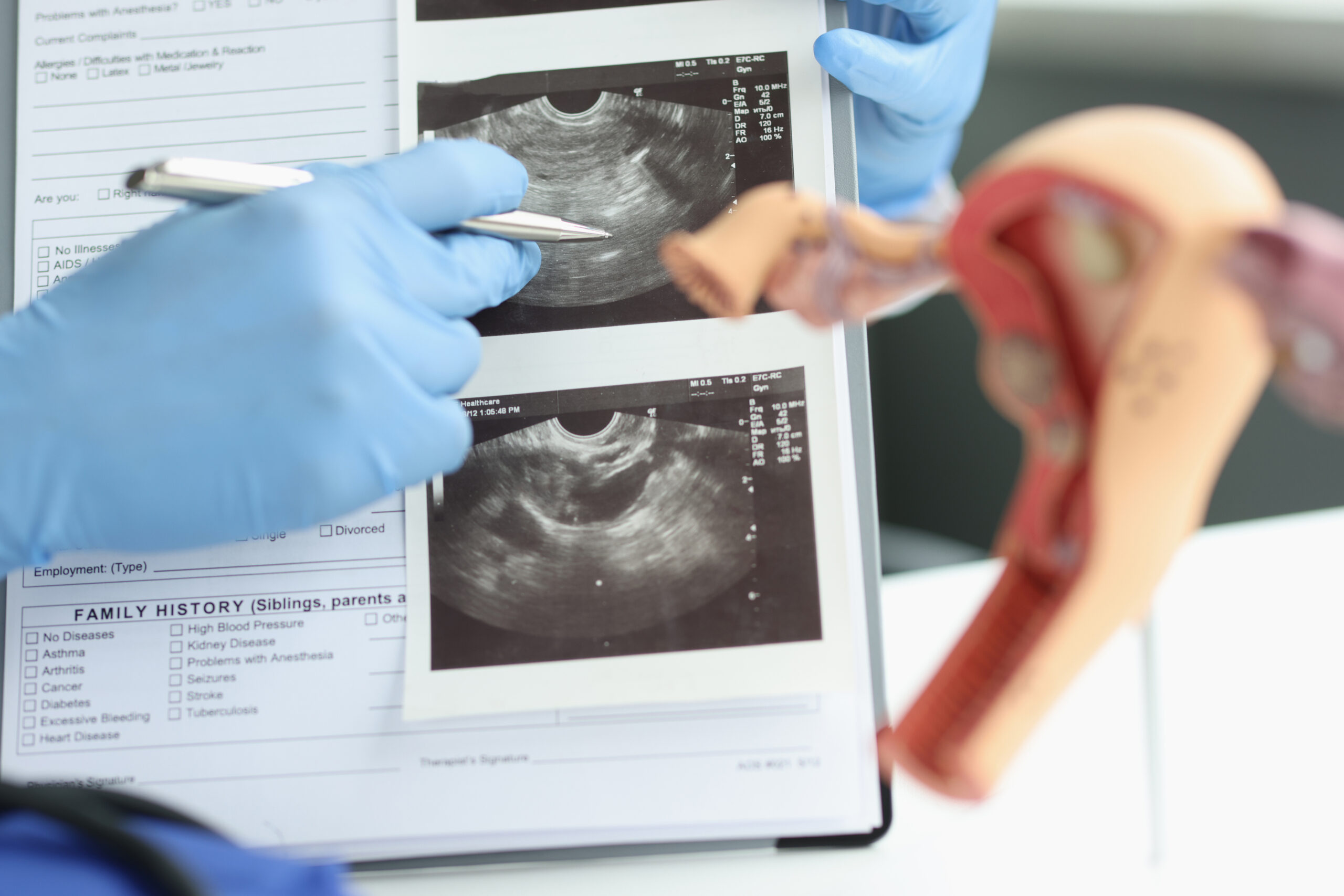Female doctor pointing at ultrasound analysis of ovary, transvaginal ultrasound of uterus