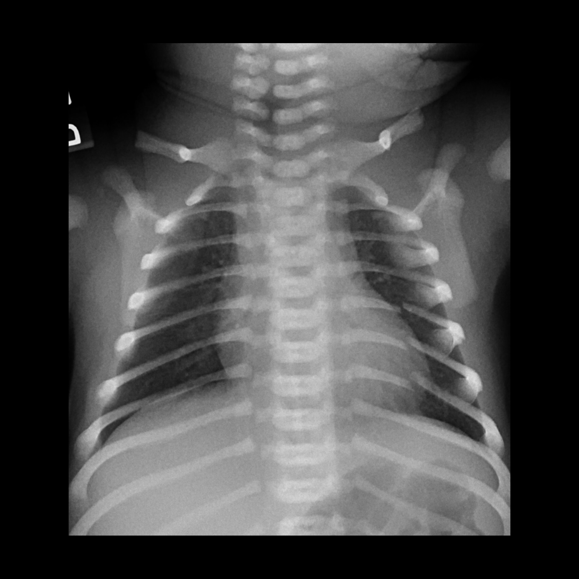 What is Shoulder Dystocia?