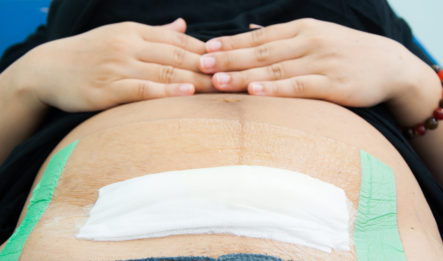 Women with hand laying on stomach after c-section infection treatment